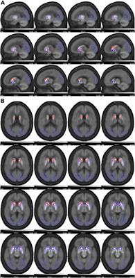 Diagnostic value of striatal 18F-FP-DTBZ PET in Parkinson’s disease